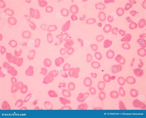 Thalassemia Blood Smear Abnormal Red Blood Cells Morphology. Stock ...