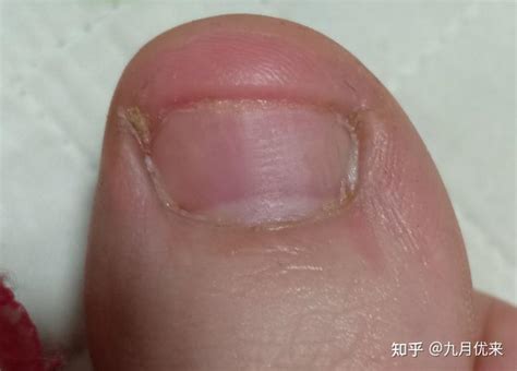 灰指甲初期症状有哪些呢？ - 知乎