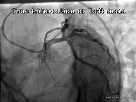 God blesses a few , with a trifurcation of their left main coronary artery ! | Dr.S.Venkatesan MD