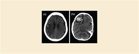 Infarct vs Hemorrhage: CT Scan Reveals the Difference – Knya
