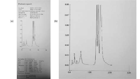 Image result for HPLC Graph