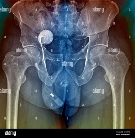 Artificial bladder sphincter. Coloured frontal X-ray showing an artificial bladder sphincter ...