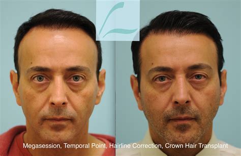 Pin by HairTX on Male Hair Transplant Results | Crown hairstyles, Hair ...