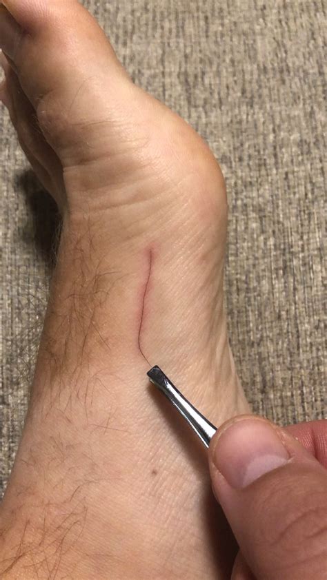 Image result for Hair Splinter Infection