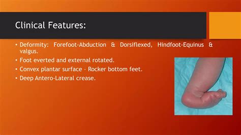 Congenital vertical talus | PPTX