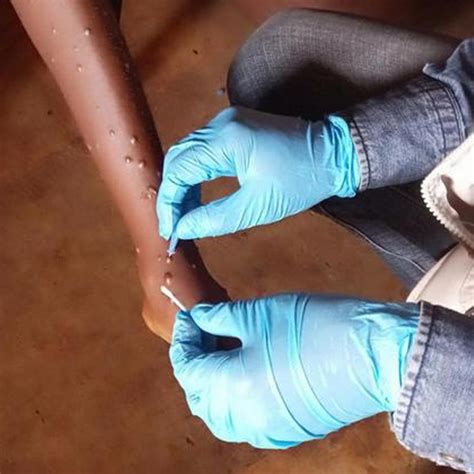 Protecting Your Family and Community from Mpox: Hygiene and Safety Measures