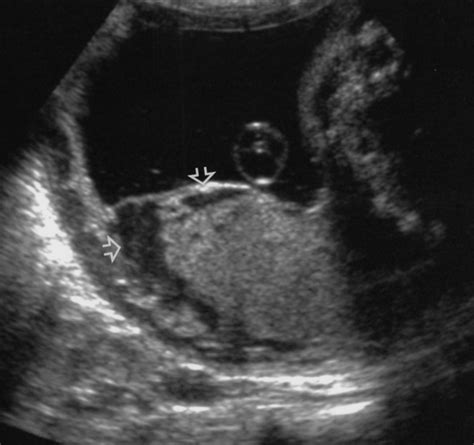 Placental Abruption Ultrasound