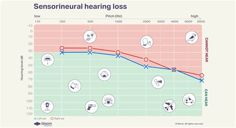 What is sensorineural hearing loss? Causes, signs & treatment