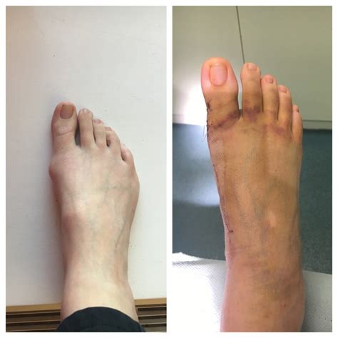 Mid foot fusion surgery - 3 weeks on - Mummy Vs Work