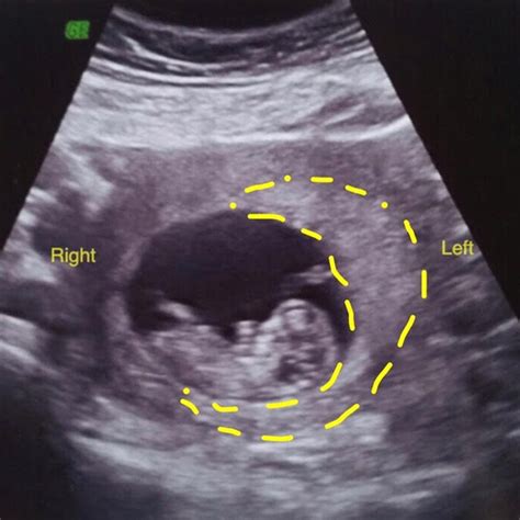 Confirmed Scans Gallery – The Gender Experts | Ultrasound pictures ...