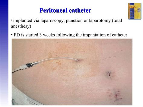 11 Peritoneal Dialysis | PPT