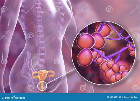 Vaginal Thrush, Female Candidiasis Stock Illustration | CartoonDealer ...