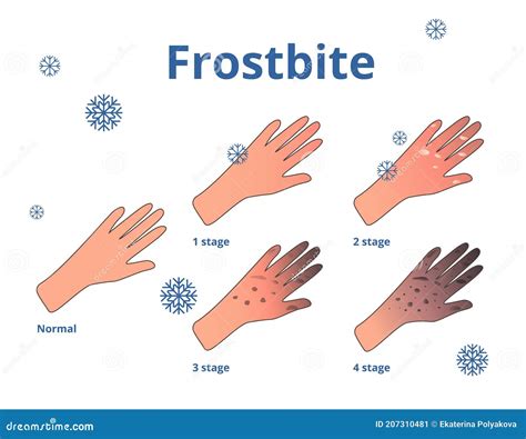 Frostbite Infographics. Symptoms, Protection And First Aid. Medical Frostbite Stage. Hypothermia ...
