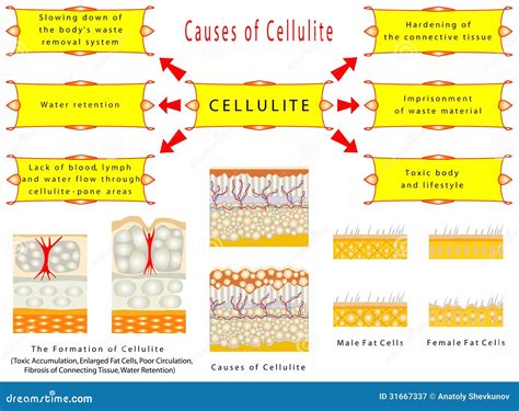 Formation of Cellulite stock vector. Illustration of bumpy - 31667337