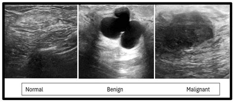 AI-Based Breast Cancer Detection System: Deep Learning and Machine Learning Approaches for ...