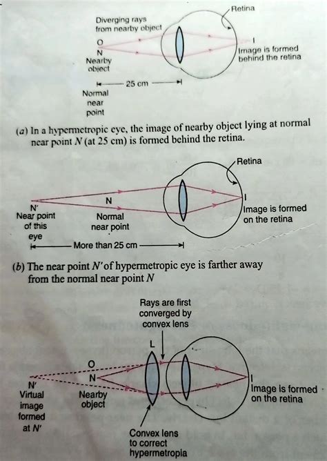 Defects of vision and their correction
