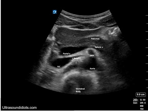 Labeled Abdominal Ultrasound Images at Brandon Myers blog