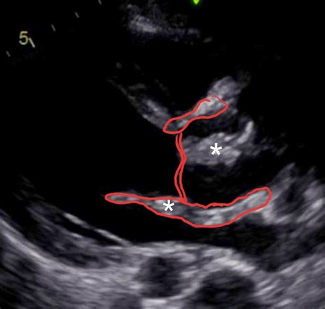 CHSS - How I Do It: The Hemi-Commando Procedure