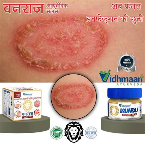 Vidhmaan Ayurvedic Vanraj Anti fungal Malam - for Ringworm, itchin ...