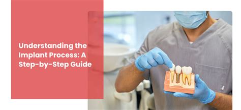 Understanding the Implant Process: A Step-by-Step Guide to Dental Implants