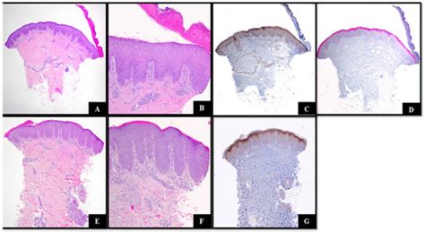 Interleukin-36 Is Highly Expressed in Skin Biopsies from Two Patients ...