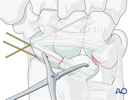 Image result for Lunate Dislocation Reduction