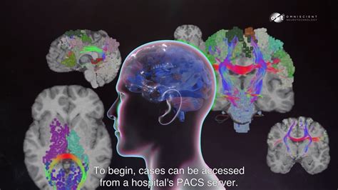 Omniscient Neurotechnology Launches Quicktome™ Brain Mapping Platform ...