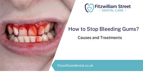 How To Stop Bleeding Gums