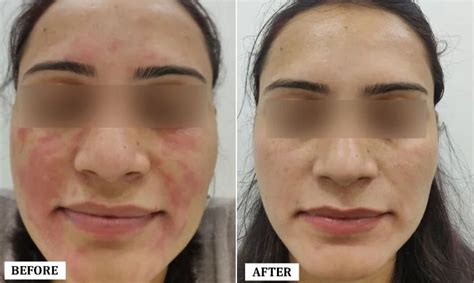 Stretch Marks Treatment in Noida | Stretch Marks Removal Cost in Noida