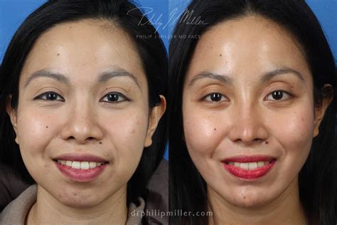 8 Signs of a Bad Nose Job | NYC Rhinoplasty Expert