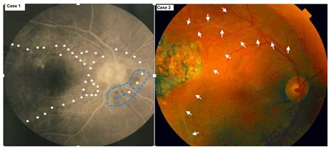 Onchocerciasis Chorioretinitis: Commonly Missed Diagnosis Spilling Over ...