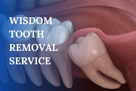 Image result for Remove Wisdom Teeth