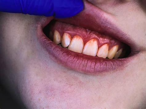 Image result for Heparin Problems