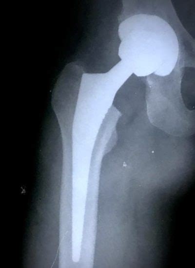 Degenerative Hip / Total Hip Replacement - Dr Abhishek Nerurkar