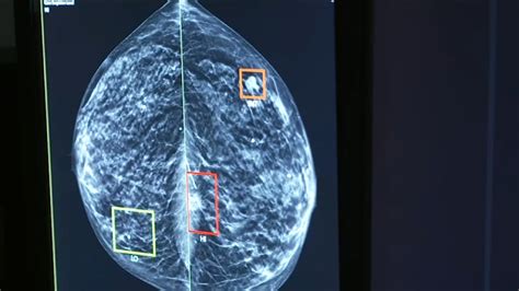 Cancer Mammogram