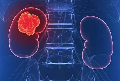 Kidney Cancer Treatment in Delhi, India Call:9811004805 | Best Kidney ...