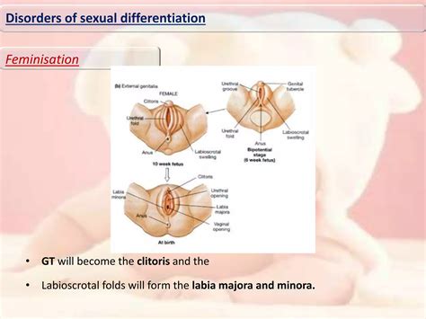 Disorders of sexual differentiation | PPTX
