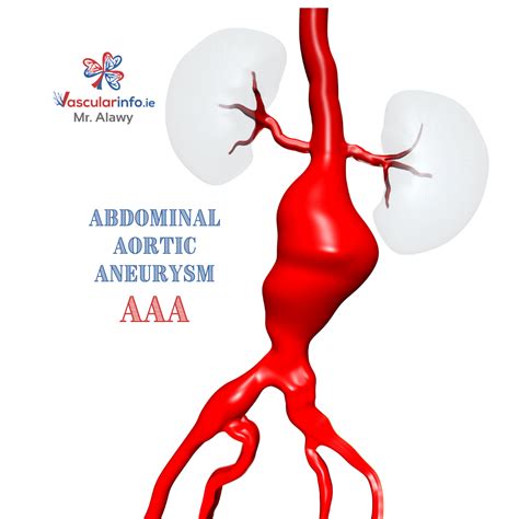 Thoracic Aortic Aneurysm - Vascular Info