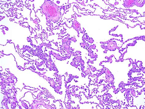 Pathology Outlines - Atypical adenomatous hyperplasia