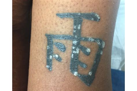 What happens if you itch a tattoo - Bronctattooaus.com