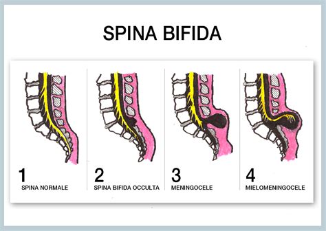 Spina Bifida Hair Patch