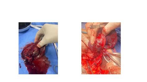Aneurysms of Visceral arteries, Splenic Artery Aneurysm in Childbearing ...