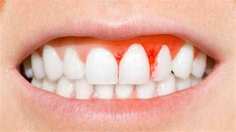 Black Lines on Teeth: Causes & Treatment Options In Bassendean