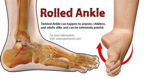 What is Rolled Ankle? Know its Treatment & Recovery Period