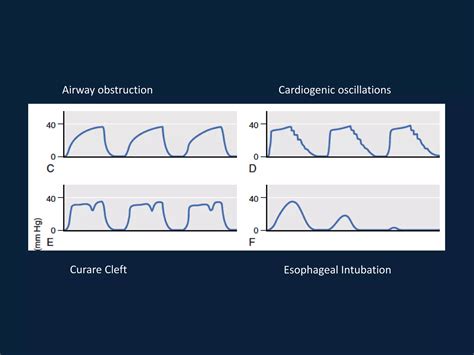 End tidal co2 and transcutaneous monitoring | PPTX