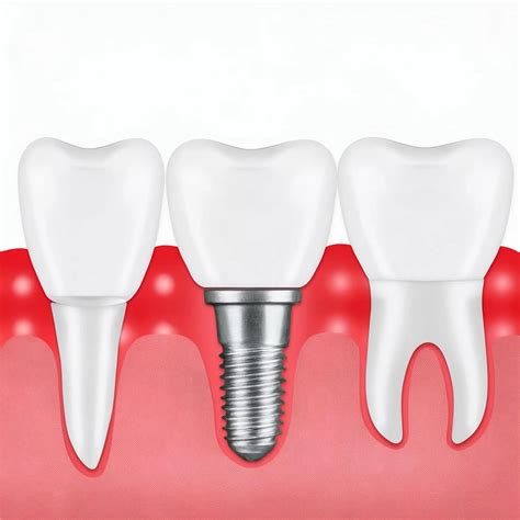 Types d'implants dentaires : Choisir la meilleure option