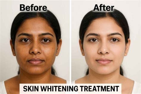 Skin Whitening Treatment in Delhi, India (2026) | Doctor-Led – The Face ...