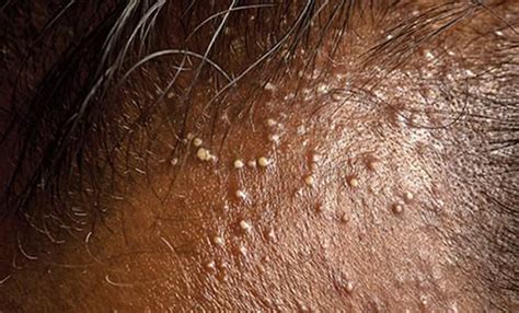 TRICHOS | Trichos Hair Loss Solution for Folliculitis Decalvans