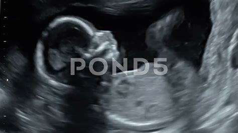 17 Weeks Pregnant Ultrasound