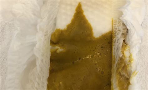 Foamy Poop And Weight Loss at Loren Griffith blog